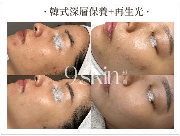 韓式深層保養+再生光